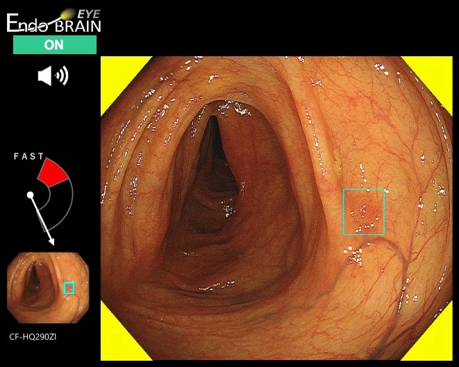 EndoBRAIN-EYE の画面例。大腸内視鏡画像の病変候補部位が水色の枠で示され、左側に ON 表示とスピードメーターが並ぶ